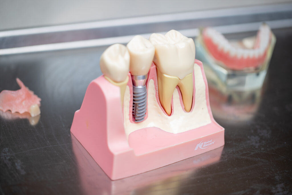 Example of what a dental implant looks like within the mouth