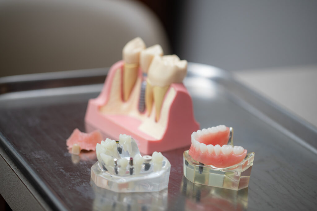 Models of teeth that show dental implants, and dentures