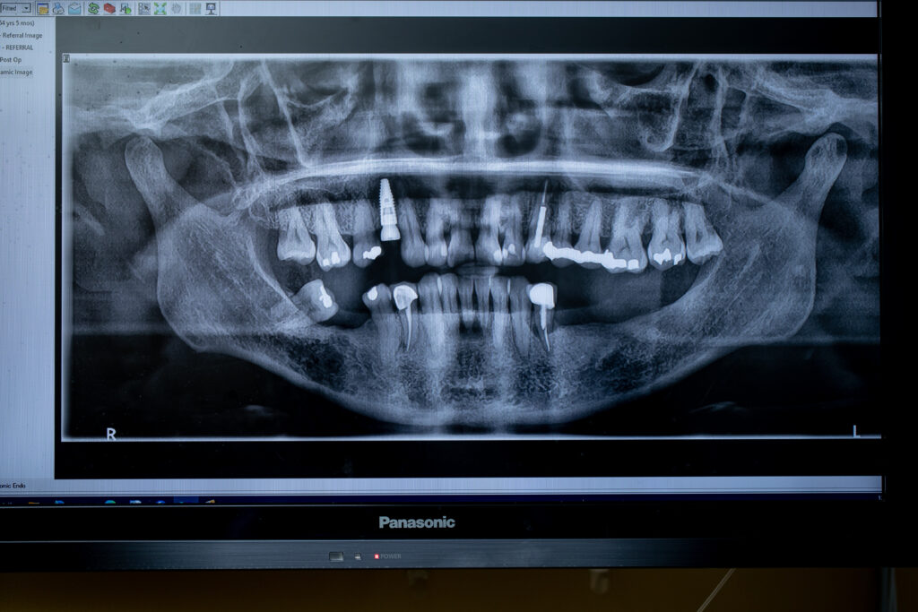 Oral surgery x-ray taken through 3-d imaging prior to surgery such as dental implants or wisdom teeth removal